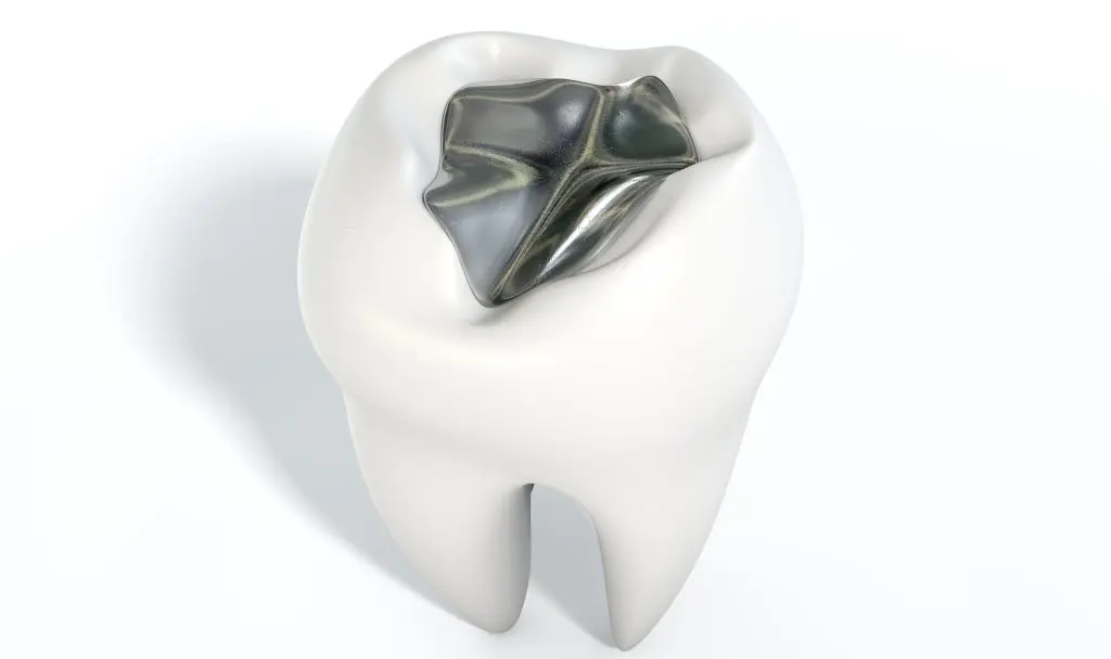 What are the Risks of a Lost Temporary Filling in an Unfinished Root Canal