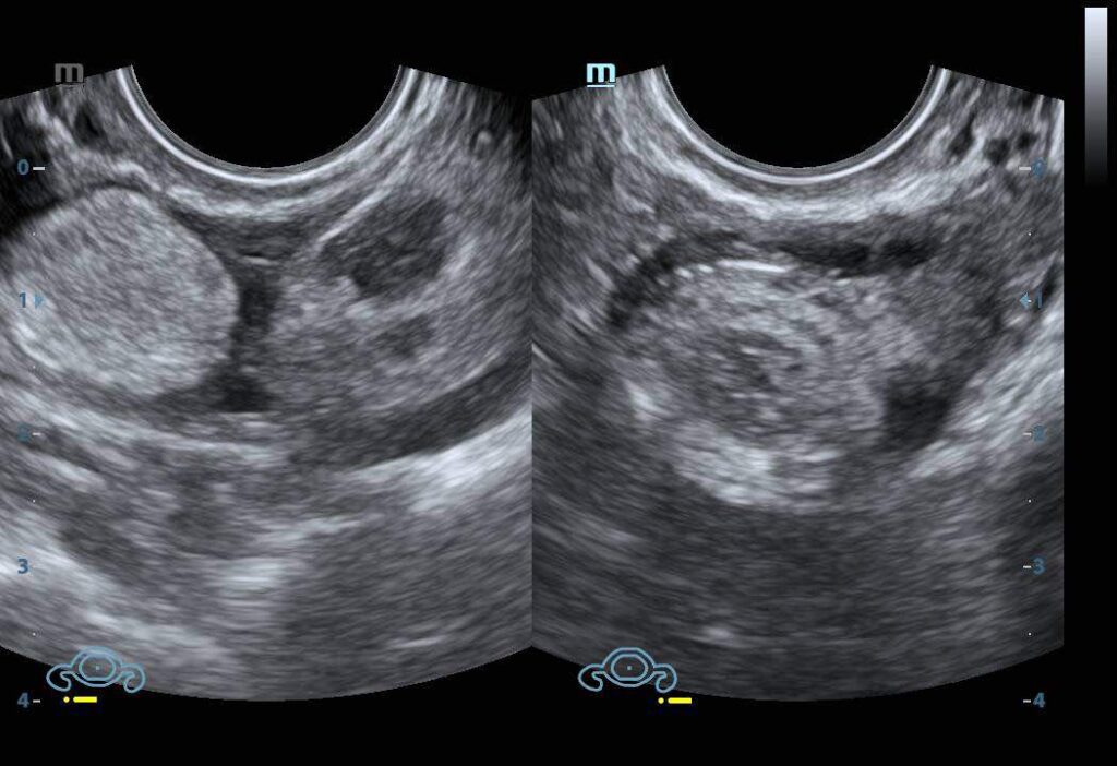 What to Do If Your Ovary is Not Visible on Ultrasound