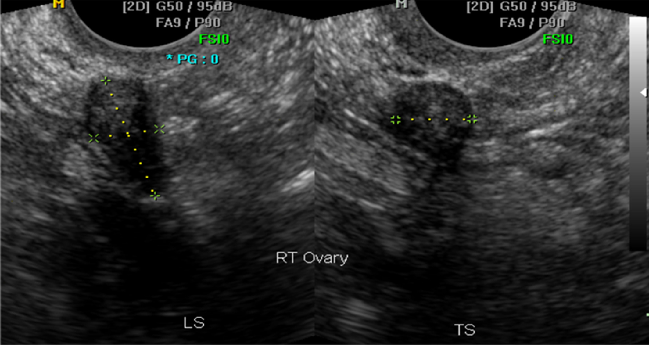 Why Is My Left Ovary Not Visible On Ultrasound