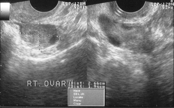 Why is My Left Ovary Not Visible on Ultrasound